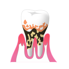 歯周病の原因について